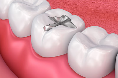 The image displays a close-up view of a human dental arch with a single visible silver filling on the left side, set against a pink background that resembles gum tissue.