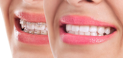 The image shows a close-up of a person s smiling face with pink lipstick, highlighting their teeth.