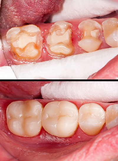 The image displays a side-by-side comparison of a person s teeth before and after dental treatment, with visible signs of decay and damage on the left and a restored smile on the right.