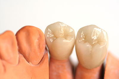 The image features a set of artificial teeth displayed on three separate plastic dental implant models, showcasing the teeth s lifelike appearance with visible details such as tooth enamel and gumline.