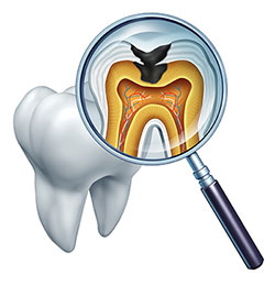 The image shows a magnified view of a tooth with an open crown, revealing the interior structure including the pulp chamber and root canals, viewed through a transparent magnifying glass with a blue handle, which is held up close to the tooth, allowing for detailed examination of its internal features.