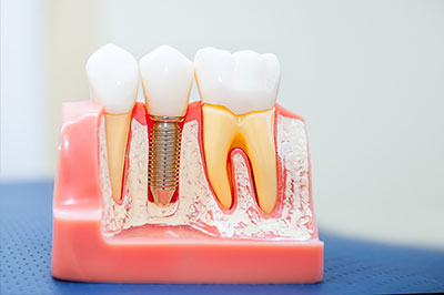 The image shows a dental model with artificial teeth and gums, featuring a close-up view of a tooth with a visible screw and a hole for a bridge or implant.