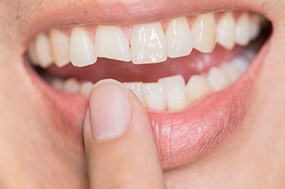 The image shows a close-up of a person s teeth with a focus on a dental implant, where the individual appears to be inspecting their own teeth, possibly for cleaning purposes.