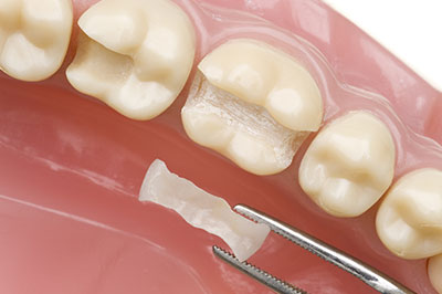 The image shows a dental implant with a screw partially inserted into a tooth-shaped prosthetic, placed on a pink dental tray.