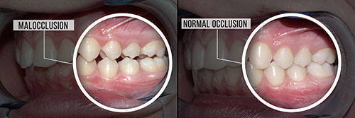 The image displays two photographs side by side of a person s mouth with teeth showing, before and after what appears to be a dental treatment or procedure, labeled  MALOCCLUSION  and  NORMAL OCCLUSION.