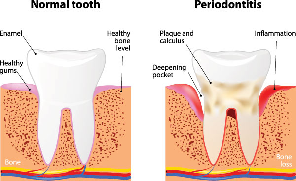 The image displays a diagrammatic representation of the progression of gum disease from normal teeth to periodontitis, highlighting the stages such as healthy bone, plaque buildup, inflammation, and bone loss with a magnified view showing the structure of a tooth and gum tissue.