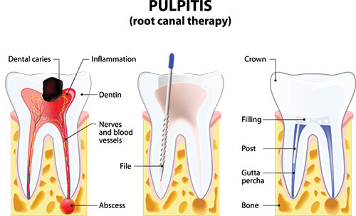 The image is an educational diagram showing the process of pulpitis  root canal therapy  on a tooth, with labeled parts including the crown, dental caries, inflammation, dentin, filling, and gutter.