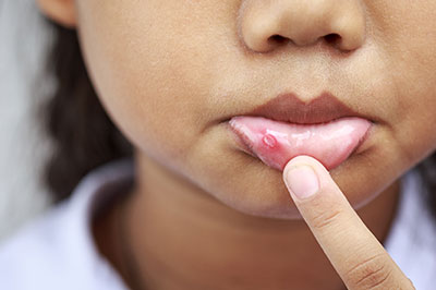 A young child with acne on their face, touching their chin with their finger.