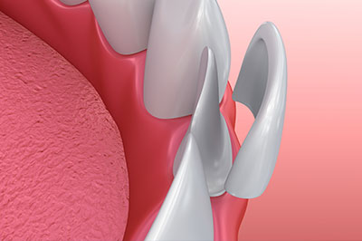 The image shows a close-up view of a dental implant with a metal abutment protruding through the gum, surrounded by pink tissue, against a blurred background that suggests a medical setting.