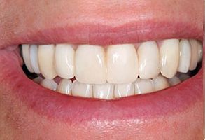 The image shows a close-up view of a person s mouth with a bright smile displaying white teeth, and the person appears to be middle-aged or older.