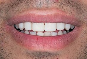 The image shows a close-up of a person s smiling mouth with teeth visible, capturing a moment of happiness or contentment.