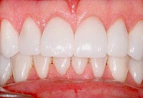 The image shows a close-up view of a person s teeth with a focus on their lower front teeth, which appear to be in need of dental work due to discoloration and possible decay.