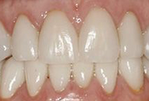 The image shows a close-up view of a person s teeth with a focus on the upper front teeth, which are white with some staining visible between them.