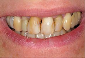 The image shows a close-up of a person s teeth with noticeable discoloration, likely from a dental condition such as staining or decay, and the individual is smiling.