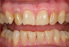 The image shows a close-up view of an individual s teeth with discoloration, likely due to dental issues such as staining or decay, requiring professional attention for cleaning and restoration.